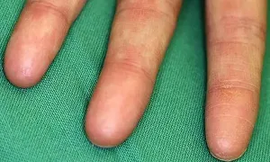 Hội chứng lạ khiến người mắc 'tàng hình' với máy quét